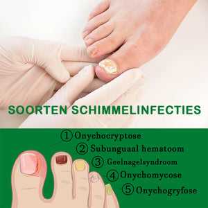 Nagelverzorging met gember